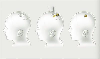 脑机接口技术将电极沉入大脑，再利用芯片与计算机进行通信。 CNET网站 图