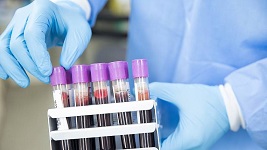 一种能比常规检测提前4年查出癌症的非侵入性血液检测方法。